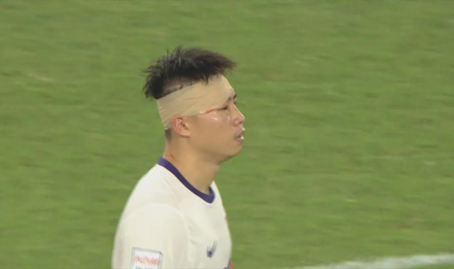 百家乐玩法-津媒：杨帆右眼眉骨受伤赛后缝针，王献钧两颗门牙直接被撞断